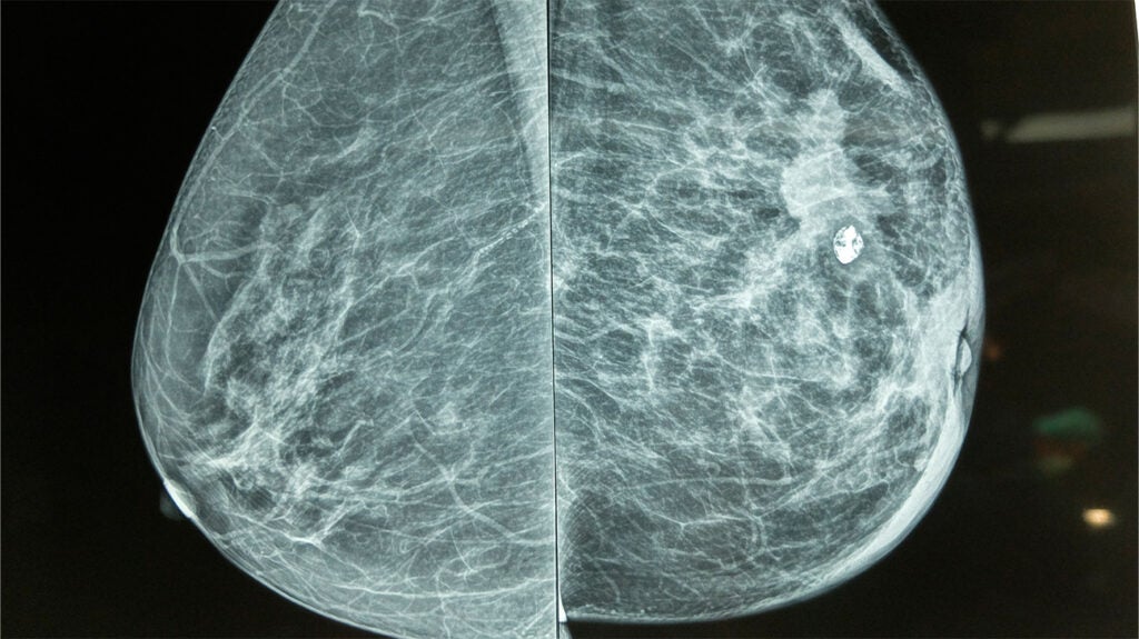 Breast Cancer Diagnosis After Missed Mammogram: Lessons From Tina Knowles' Experience Breast Cancer Diagnosis After Missed Mammogram: Lessons From Tina Knowles' Experience